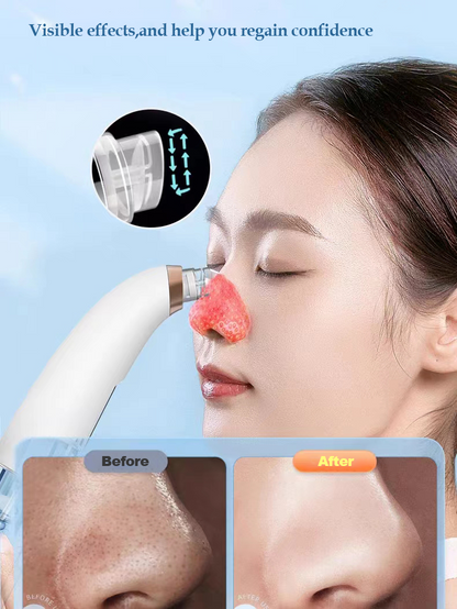 Electric Bubble Blackhead/Pimple Remover